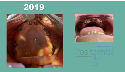 Mise en charge immédiate positdental 05 e9bsdy - Eugenol