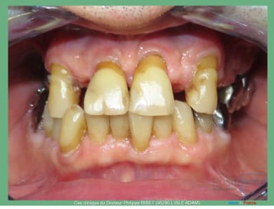 Mise en charge immédiate positdental r - Eugenol