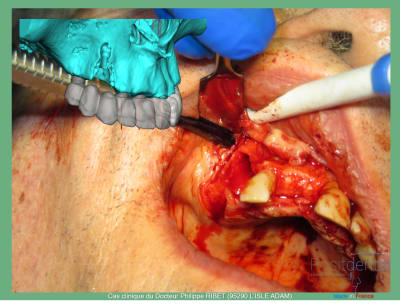 Mise en charge immédiate positdental r - Eugenol