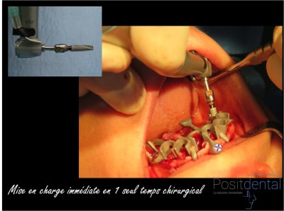 Mise en charge immédiate chirurgie guidée 008 sw2wuu - Eugenol