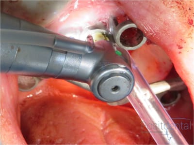 Mise en charge immédiate chirurgie guidée 011 jhtnrm - Eugenol