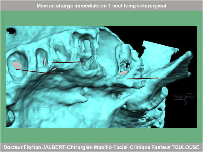 Mise en charge immédiate en 1 seul temps chirurgical protocole positdental 059 tov5b4 - Eugenol