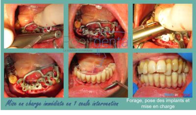 Mise en charge immédiate en 1 seule intervention la solution immédiate positdental 004 x5smlt - Eugenol