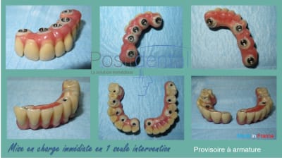 Mise en charge immédiate en 1 seule intervention la solution immédiate positdental 009 vpue1c - Eugenol