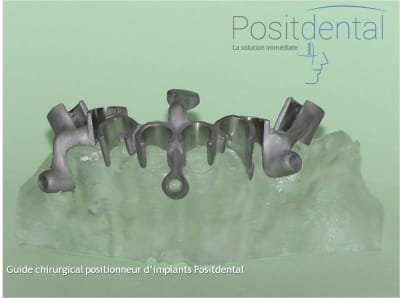 Mise en charge immédiate en chirurgie guidée   positdental 001 ftpwit - Eugenol