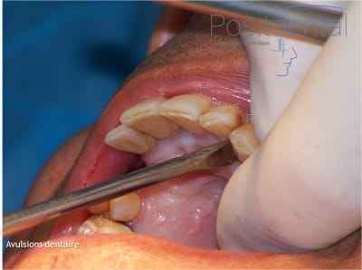 Mise en charge immédiate en chirurgie guidée   positdental 005 xq73xt - Eugenol