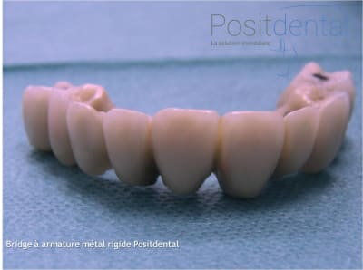 Mise en charge immédiate en chirurgie guidée   positdental 025 lm2gun - Eugenol