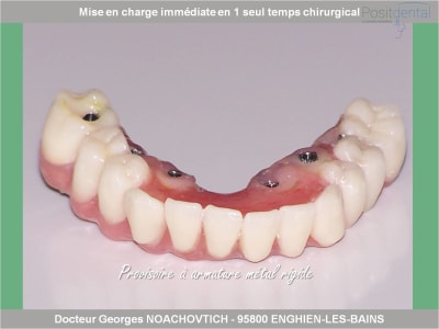 Mise en charge immédiate en chirurgie guidée positdental 009 vjuhng - Eugenol