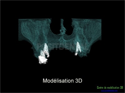 Mise en charge immédiate implant dentaire 012 fvsoqt - Eugenol