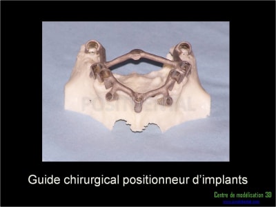 Mise en charge immédiate implant dentaire 015 w08fro - Eugenol