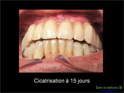 Mise en charge immédiate implant dentaire 021 njwawy - Eugenol
