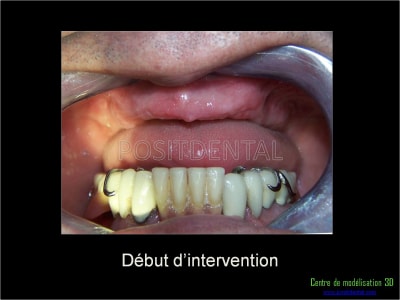 Mise en charge immédiate implant dentaire 025 l4umuw - Eugenol