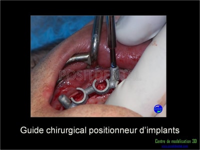 Mise en charge immédiate implant dentaire 029 psuepi - Eugenol