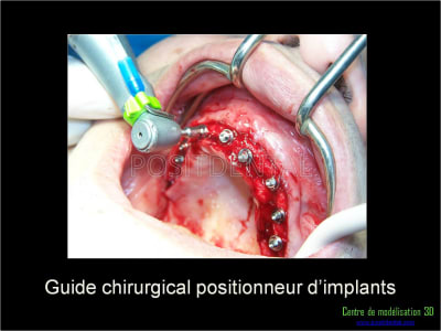 Mise en charge immédiate implant dentaire 044 j52lbx - Eugenol