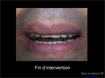 Mise en charge immédiate implant dentaire 049 rubtjs - Eugenol