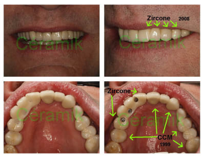 Montage ccm zircone 2  wlksql - Eugenol