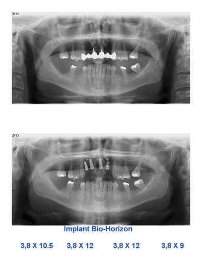 Montage pano sopm60 - Eugenol