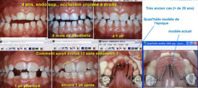 Occlusion croisee 4 ans dzpesp - Eugenol
