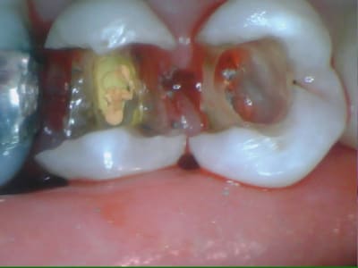 Onlay 24 r8ua3a - Eugenol