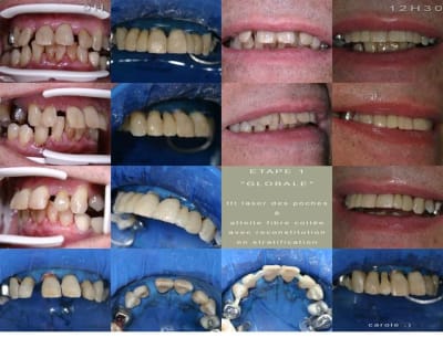 Paroattelle light qvl1rf - Eugenol