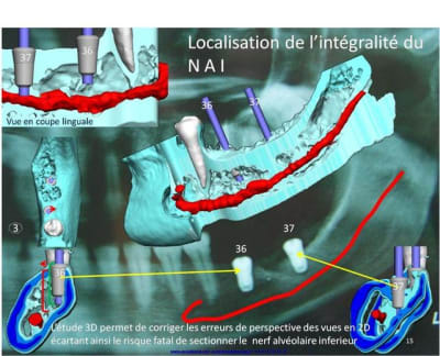 Positdental localisation du nai gybdxk - Eugenol