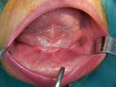 Positdental  014 ayk6h0 - Eugenol