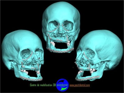 Positdental 1 - Eugenol