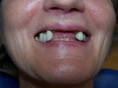 Positdental 150528 005 htbn5m - Eugenol