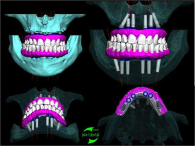 Positdental all on 6 dmncp3 - Eugenol