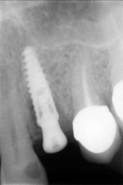 Post op blar2a - Eugenol