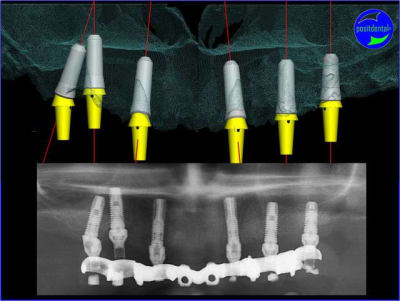 Pano 3d positdental egcieb - Eugenol