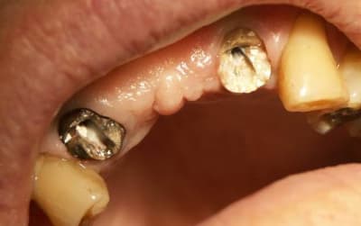 Patient1 jbod4y - Eugenol