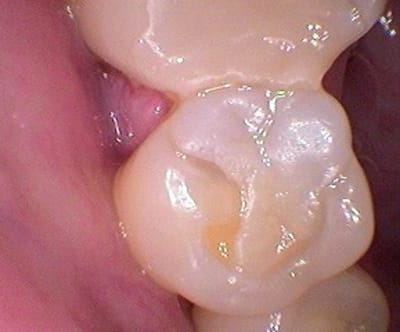 Patient 7 mqhfq6 - Eugenol