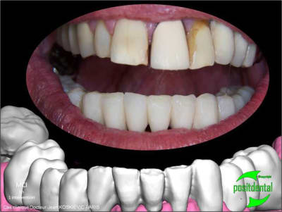 Planification implantaire assist e par ordinateur oxpobg - Eugenol