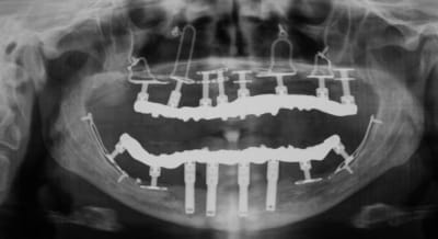 Plaques01 xd6wqq - Eugenol