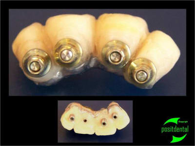 Porte implant triple focntion euroteknika 2 y1uhxn - Eugenol