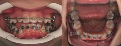 Pose arc inf. 0 - Eugenol