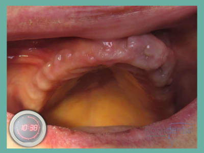 Positdental mise en charge immédiate 004 ecl5jo - Eugenol