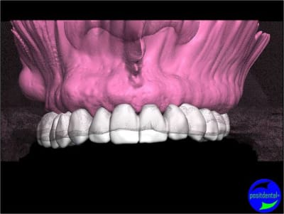 Positdental 002 dhinbu - Eugenol