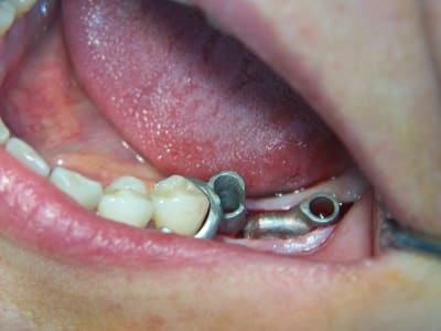 Positdental 015 qvhxmc - Eugenol