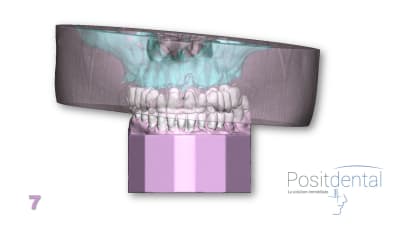 Positdental mci mise en charge immédiate 007 yb4km7 - Eugenol