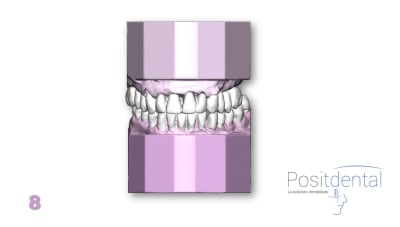 Positdental mci mise en charge immédiate 008 hjvpqt - Eugenol