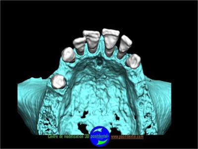 Positdental planification 3d 1 hggwfh - Eugenol
