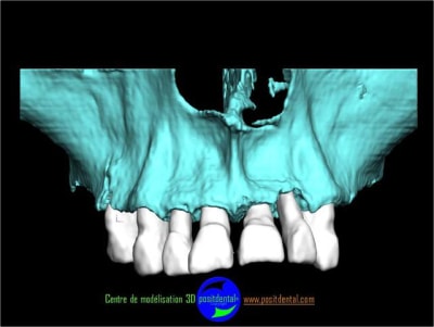 Positdental planification 3d 2 nsrap9 - Eugenol