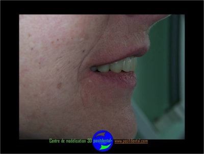 Positdental planification 3d 5 eglfub - Eugenol