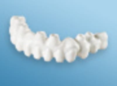 Procera implant bridge zirconia tcm59 4449 bot1cu - Eugenol