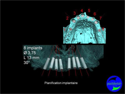 Protocole mci post extractionnelle positdental 004 iryxmp - Eugenol