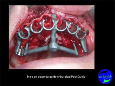 Protocole mci post extractionnelle positdental 012 isvgvf - Eugenol