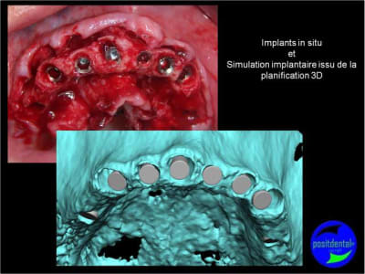 Protocole mci post extractionnelle positdental 019 clcy5r - Eugenol