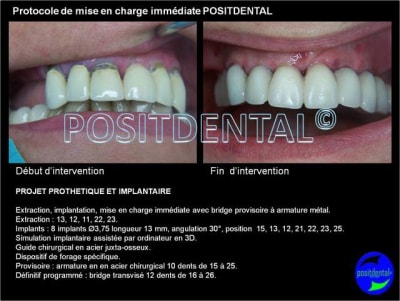 Protocole de mise en charge imm diate positdental 001 agoalt - Eugenol
